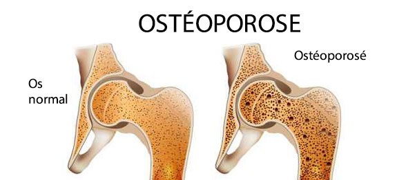 osteoporose.jpg